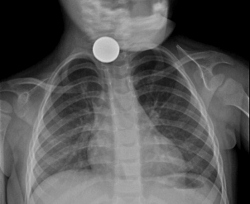 צילום הרנטגן של הפעוטה(צילום:דוברות רמב"ם)